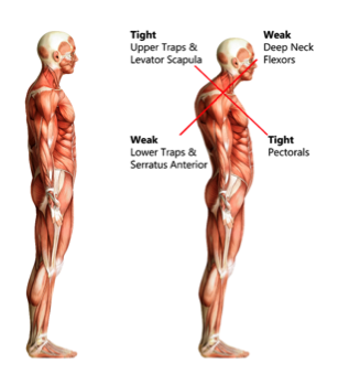 Image result for muscle imbalance back